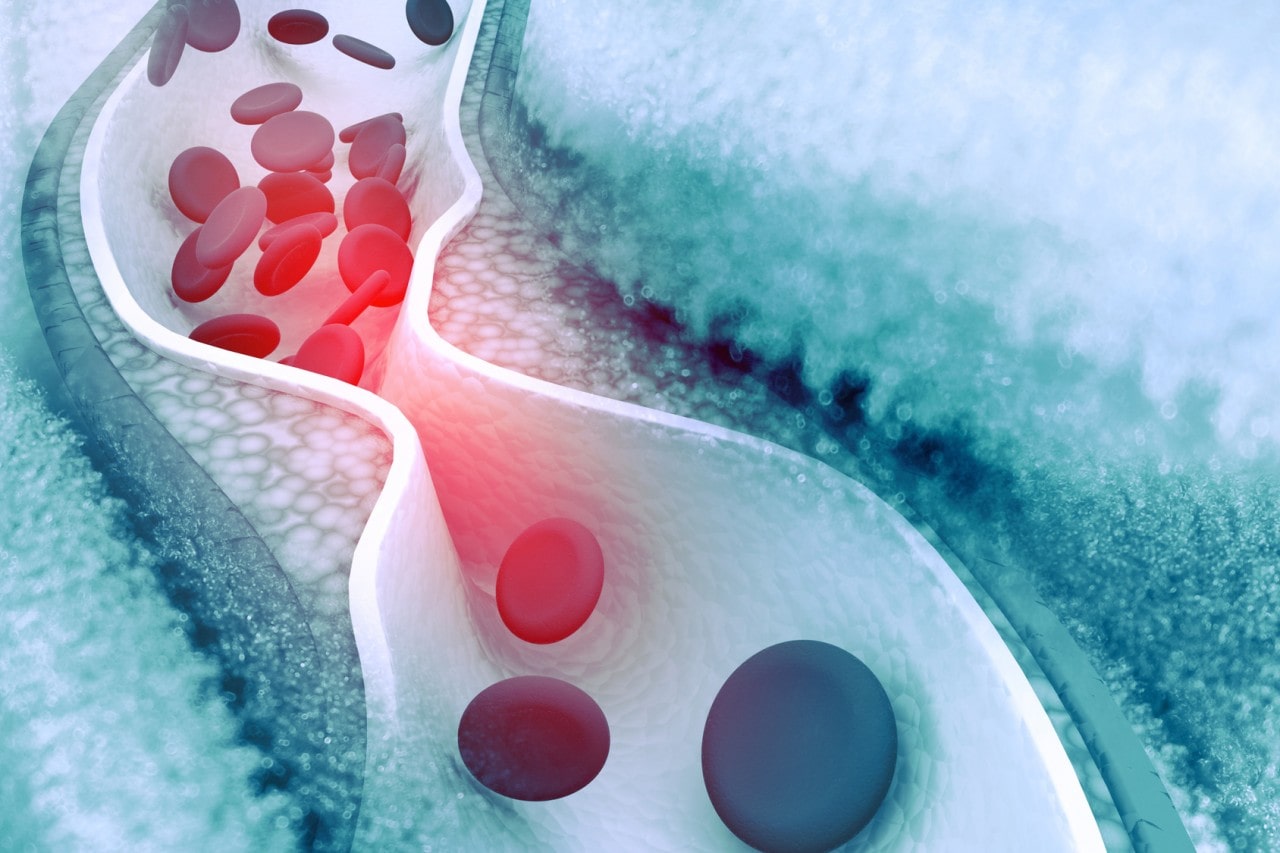 Cholesterin, Arteriosklerose und Fettstoffwechselstörungen